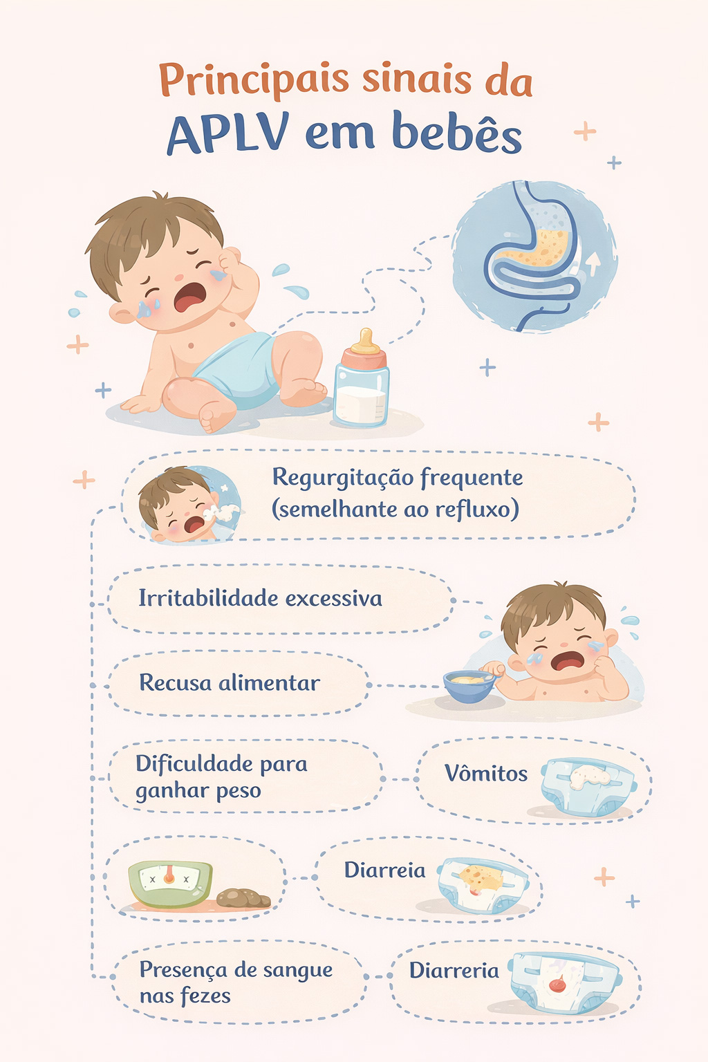 Os principais sintomas da APLV em bebês são: regurgitação frequente (semelhante ao refluxo), irritabilidade excessiva, recusa alimentar, dificuldade para ganhar peso, vômitos, diarreia e presença de sangue nas fezes.